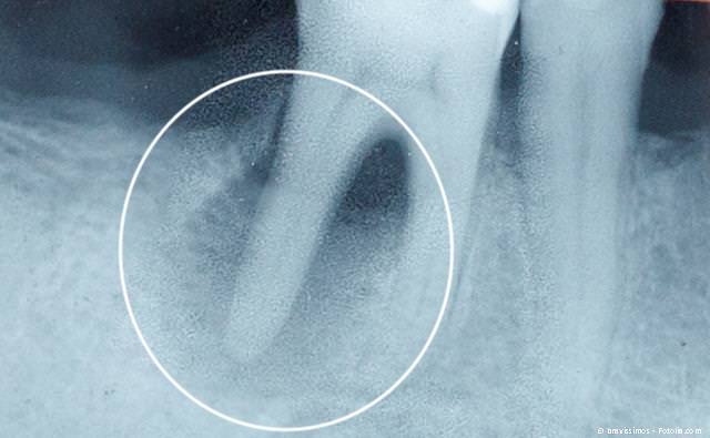 Wurzelbehandlung: Eigene Zähne erhalten und Geld sparen