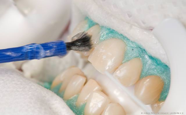 In-Office-Bleaching: Schnelle Zahnaufhellung in der Praxis