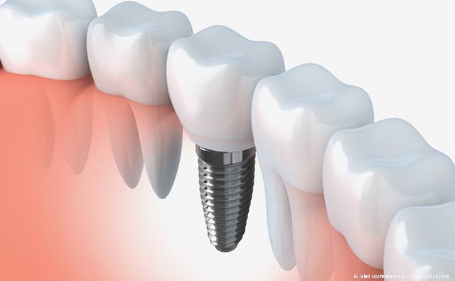 Zahnimplantate. künstliche Zahnwurzeln