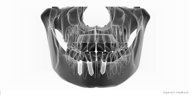 3D-Implantatplanung für mehr Sicherheit