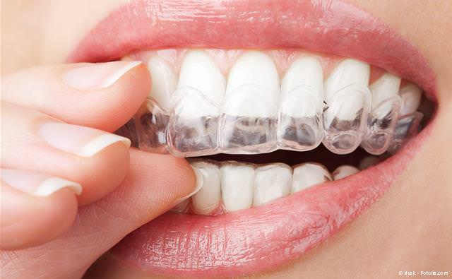 Aligner werden einfach auf die Zähne aufgesetzt und können jederzeit zwischendurch abgenommen werden.
